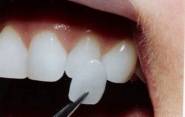 تفاوت میان لومینیرز و لمینت سرامیکی