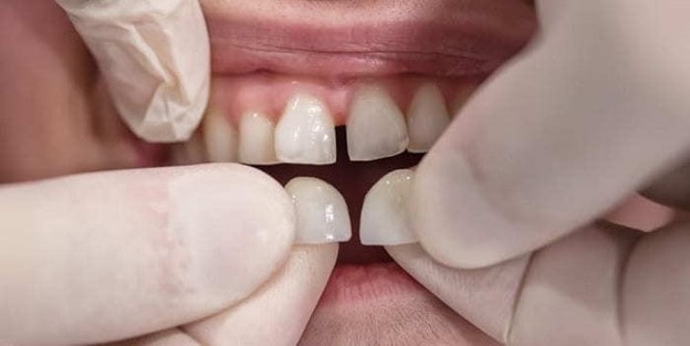 لمینت چطور بر روی دندان نصب می شود؟