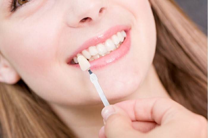 لمینت چیست؟