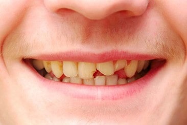 کاندید مناسب برای لمینت و لومینیرز