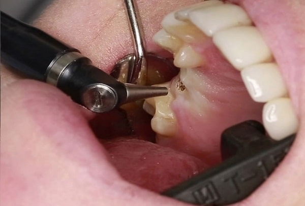 روش‌های مورد استفاده توسط متخصص ایمپلنت