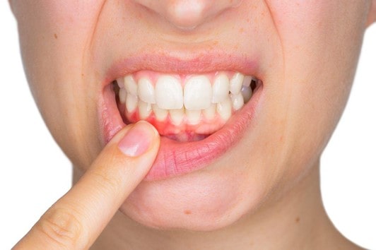 آیا کامپوزیت‌های دندانی می توانند باعث بیماری لثه شوند؟