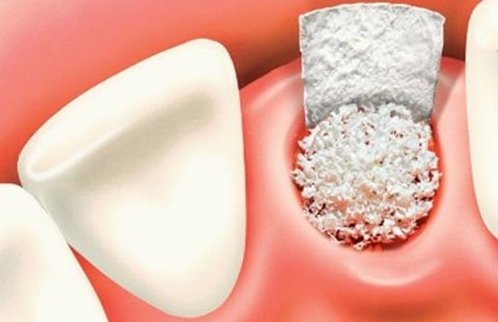 روش Socket graft برای پیوند استخوان فک