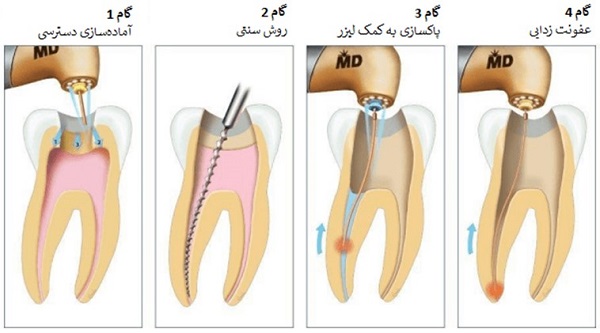 روند عصب کشی با لیزر چگونه است؟