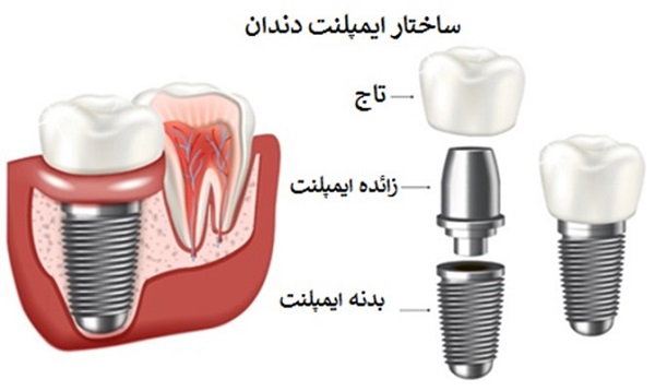 فاکتورهای مهم در تعیین قیمت ایمپلنت