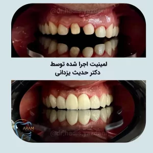 Dental lamination