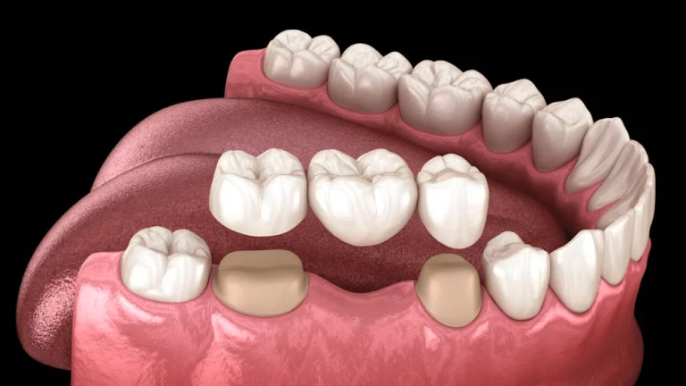 بریج دندان چیست