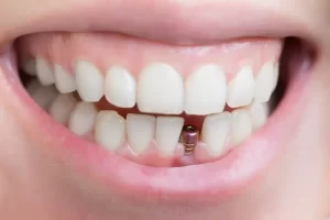 آیا ایمپلنت دندان جلو درد دارد؟