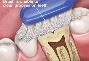 فیشور سیلانت دندان شیری