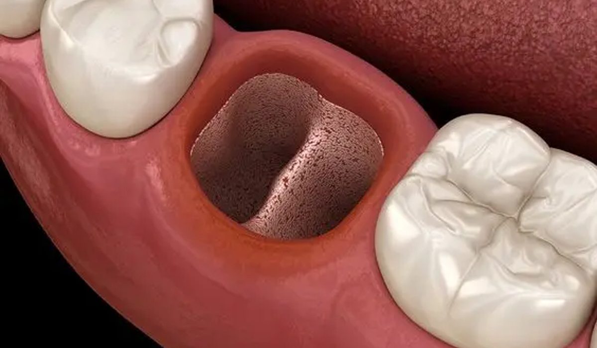 حفره خشک دندان-مرکز دندانپزشکی گیشا آرام