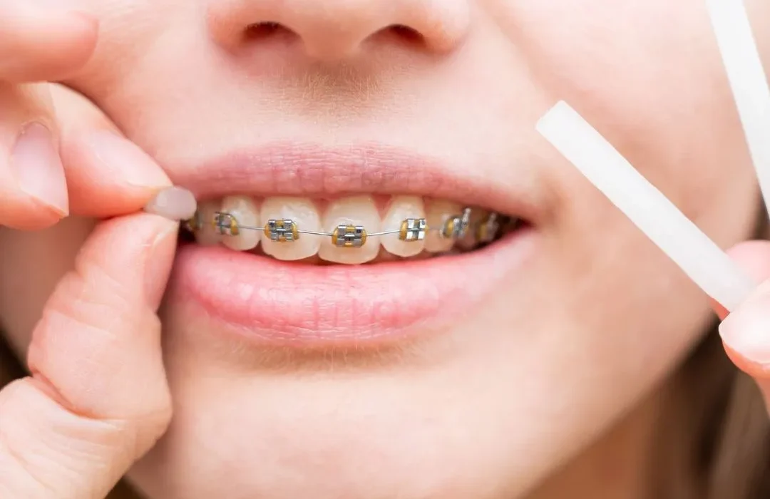 انواع نخ دندون برای ارتودنسی-مرکز دندانپزشکی گیشا آرام