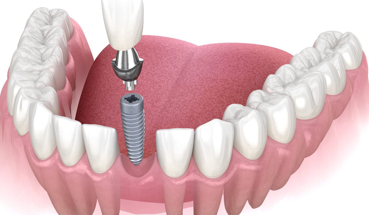 ایمپلنت دندان جلو-آرام دنتال