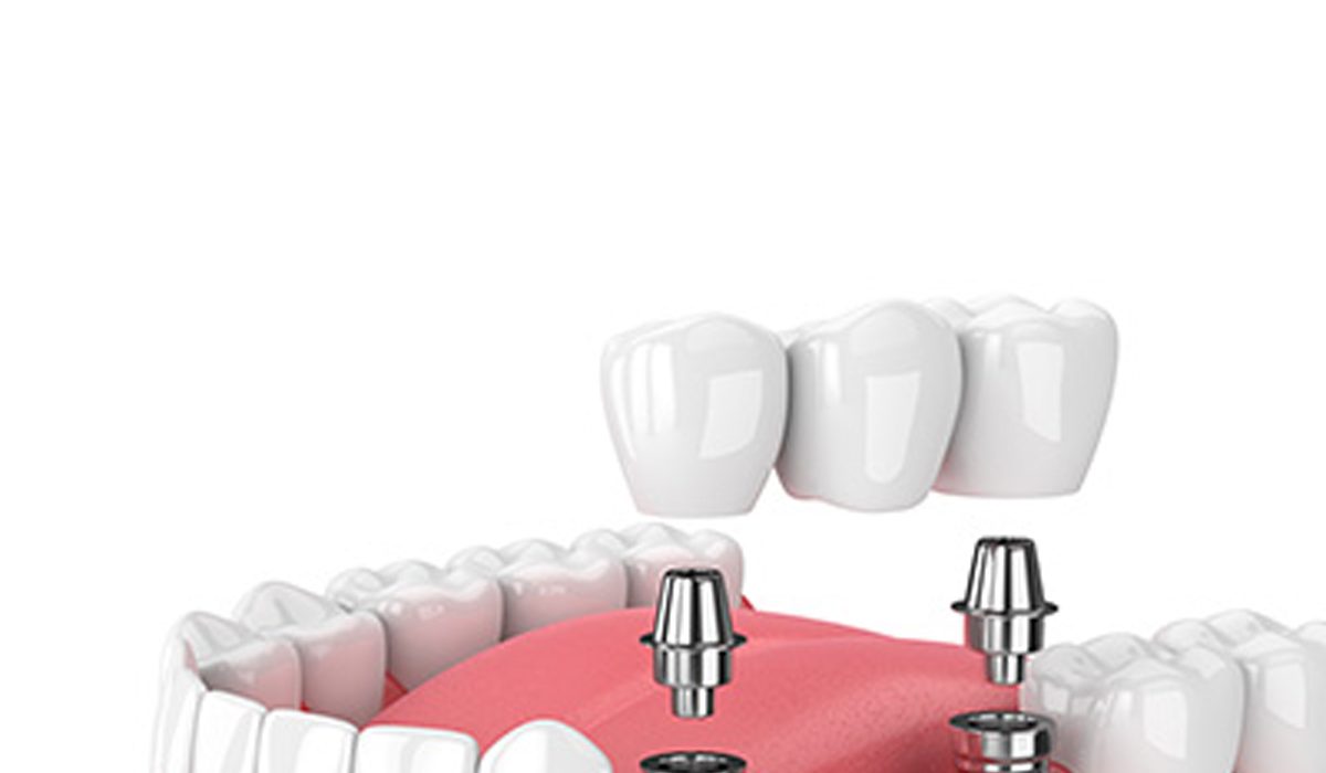 بریج دندان چیست-آرام دنتال