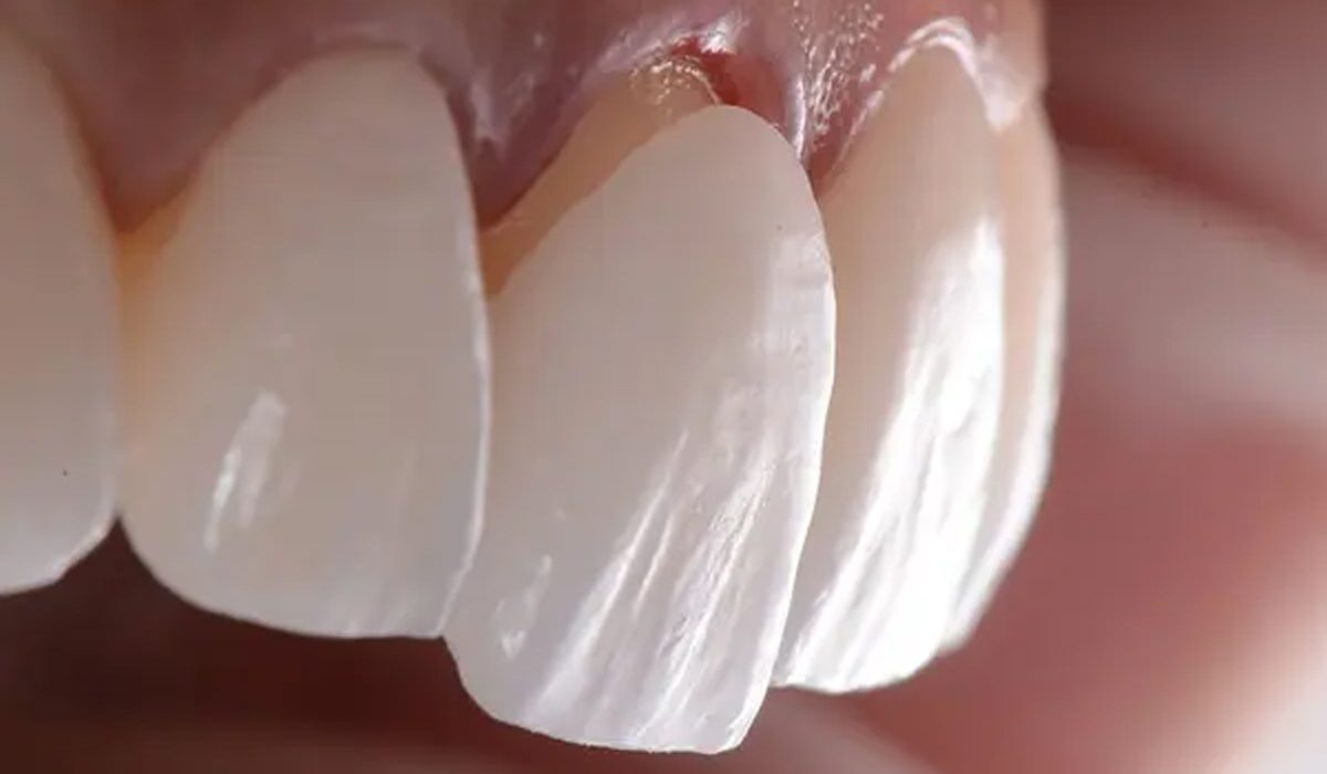 تفاوت لمینیت و کامپوزیت-آرام دنتال