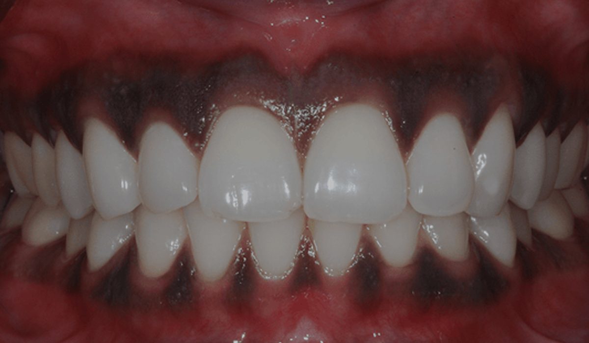 درمان سیاه شدن لثه- آرام دنتال