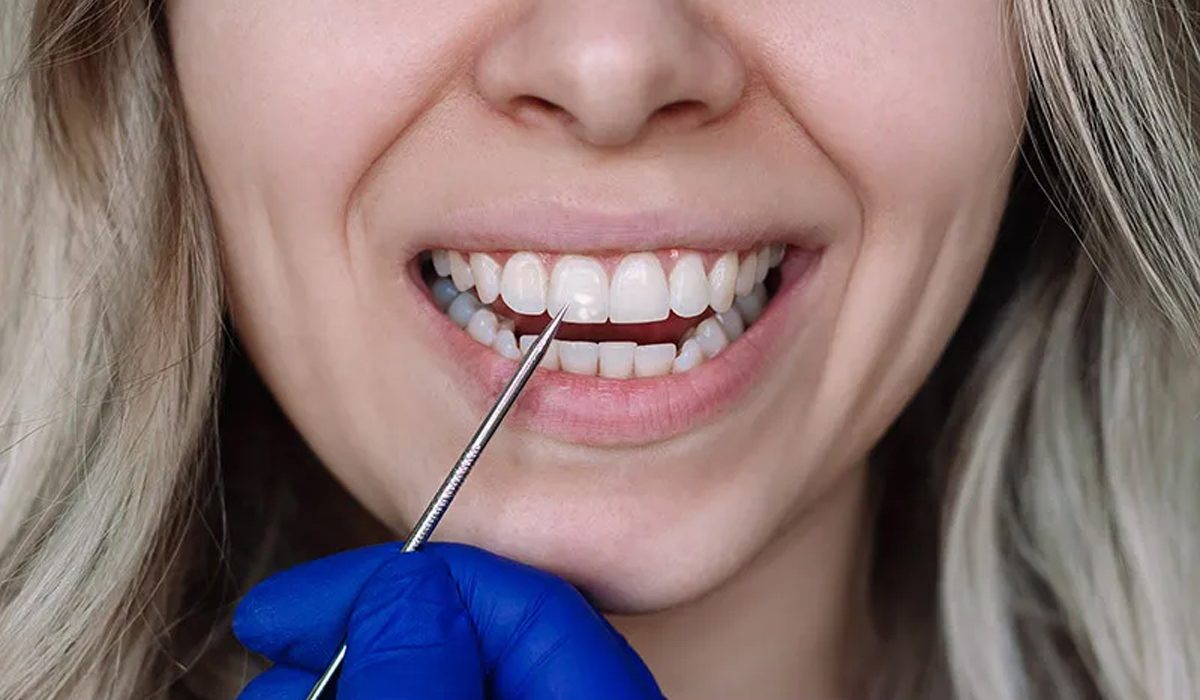 لکه-سفید-روی-دندان-آرام-دنتال