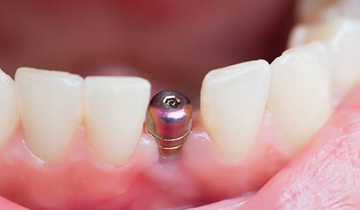پس زدن ایمپلنت دندان-آرام دنتال