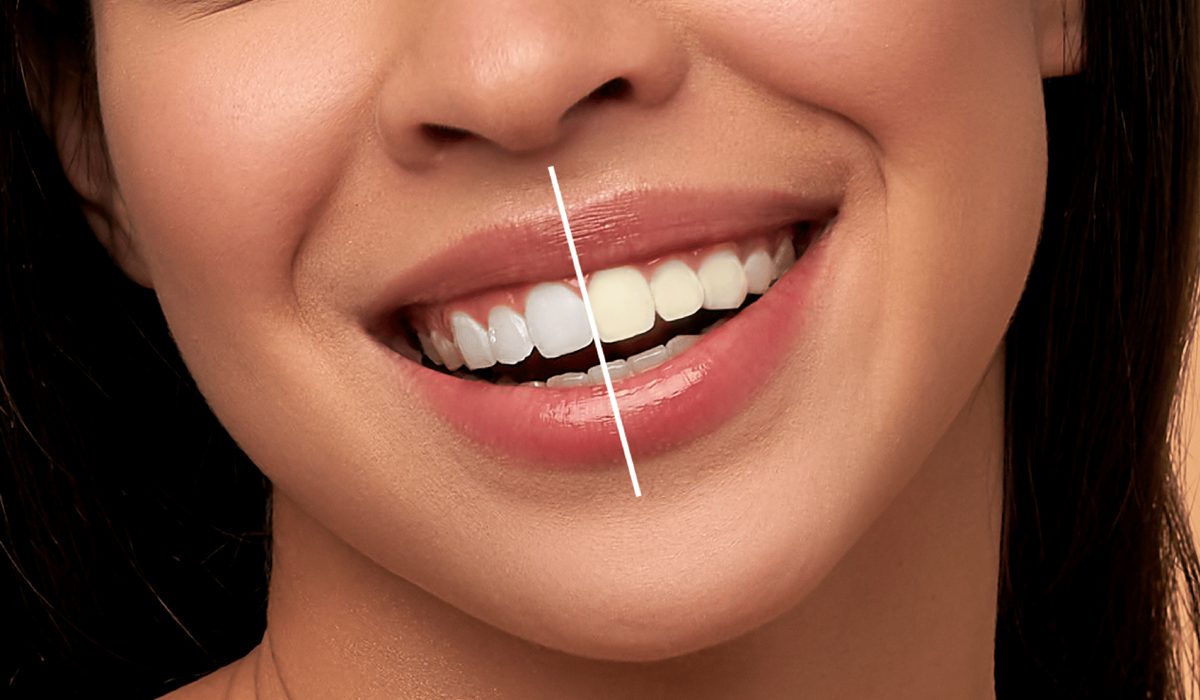 اصلاح طرح لبخند-مرکز دندانپزشکی گیشا آرام