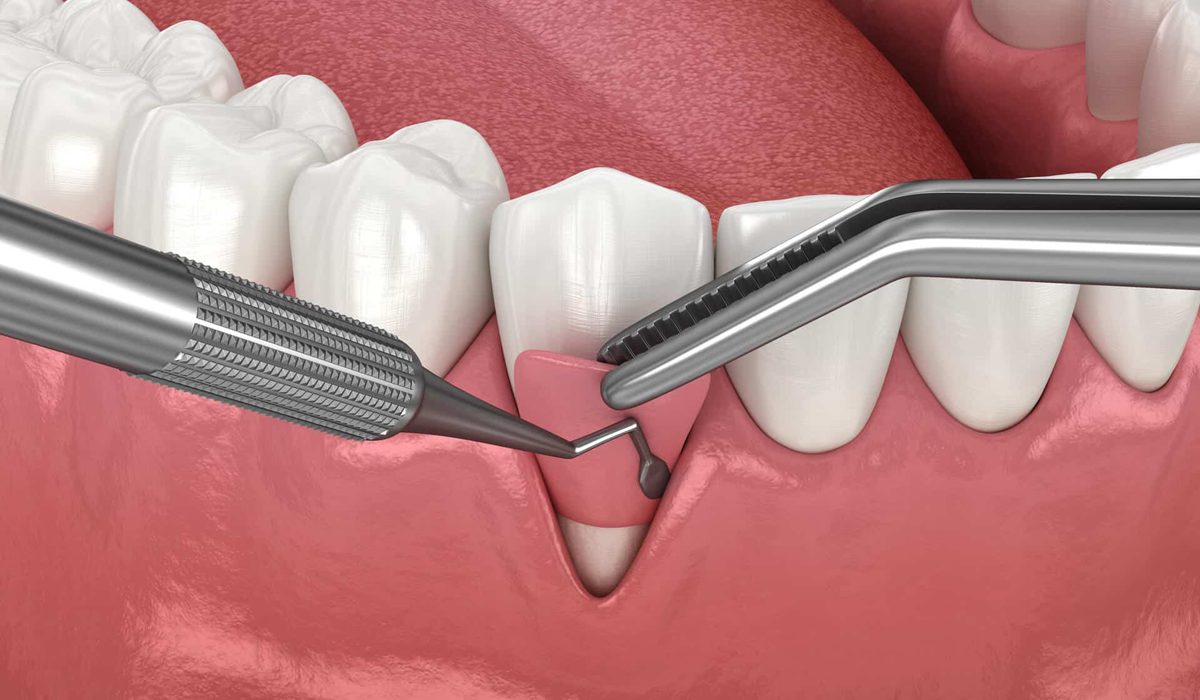 انواع جراحی لثه-مرکز دندانپزشکی گیشا آرام