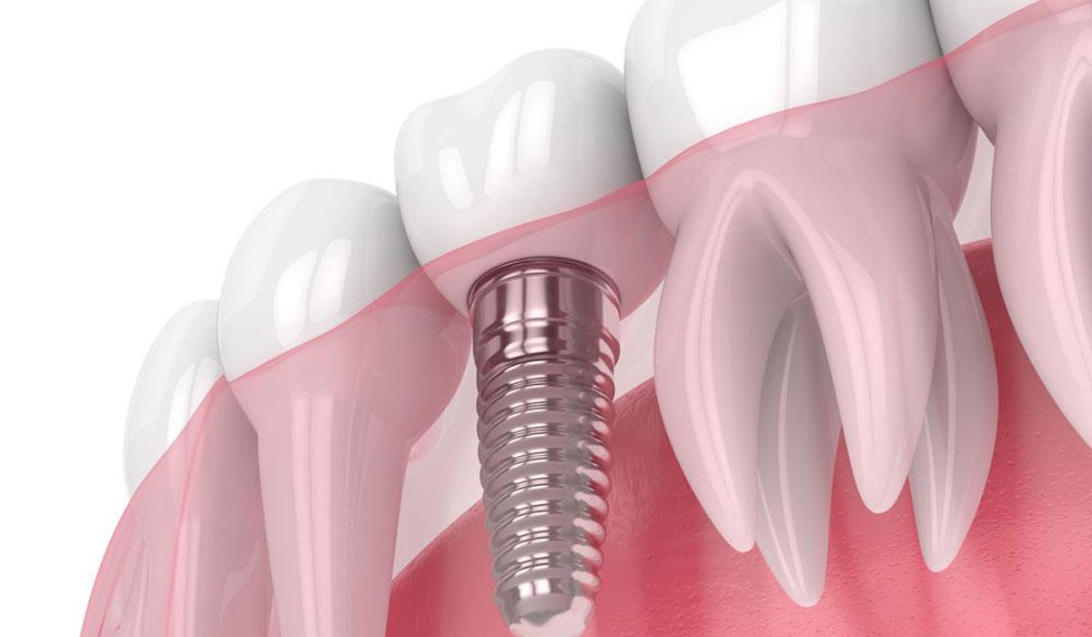 ایمپلنت فوری-مرکز دندانپزشکی آرام