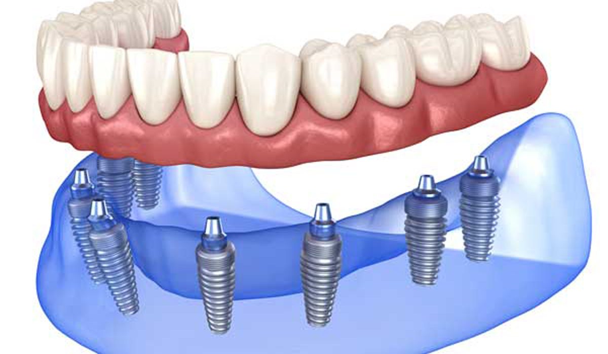 ایمپلنت متحرک-مرکز دندانپزشکی آرام