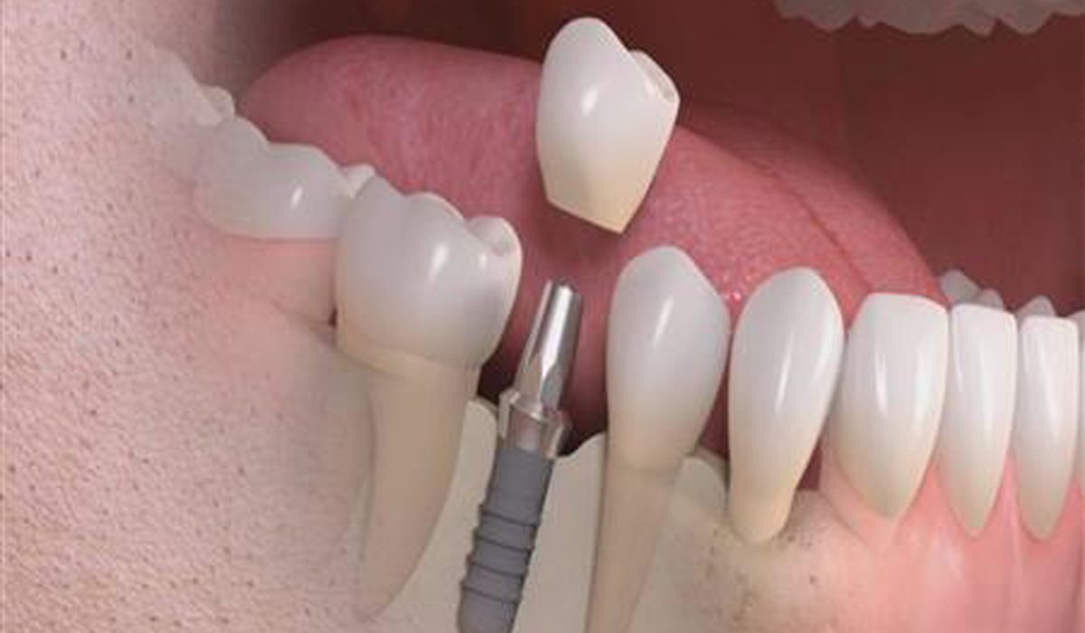 ایمپلنت های سوئیسی-مرکز دندانپزشکی گیشا آرام