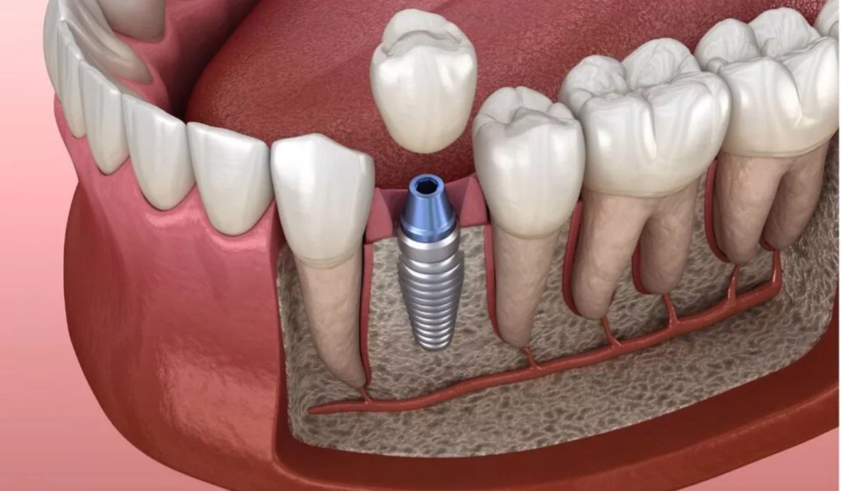 ایمپلنت دندان - مرکز دندانپزشکی گیشا آرام