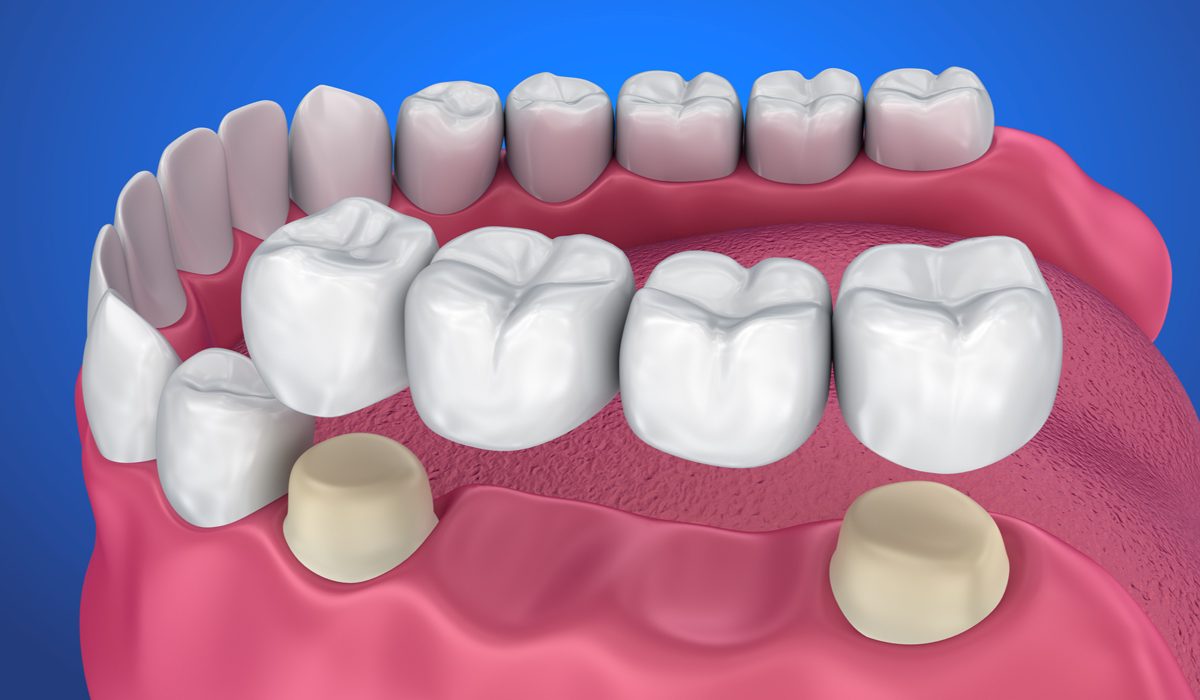 بریج دندان-مرکز دندانپزشکی گیشا آرام