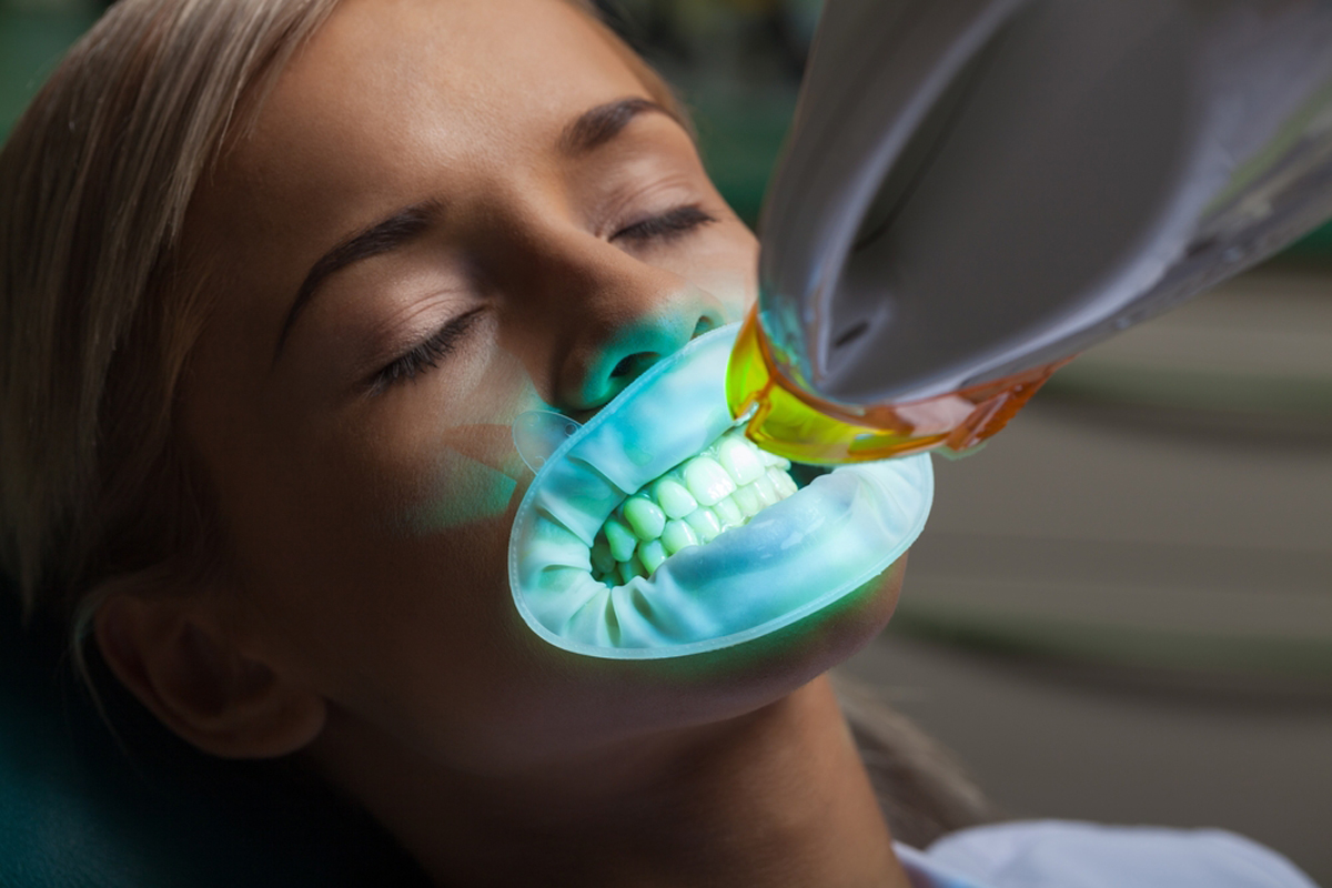 بلیچینگ دندان - مرکز دندانپزشکی گیشا آرام