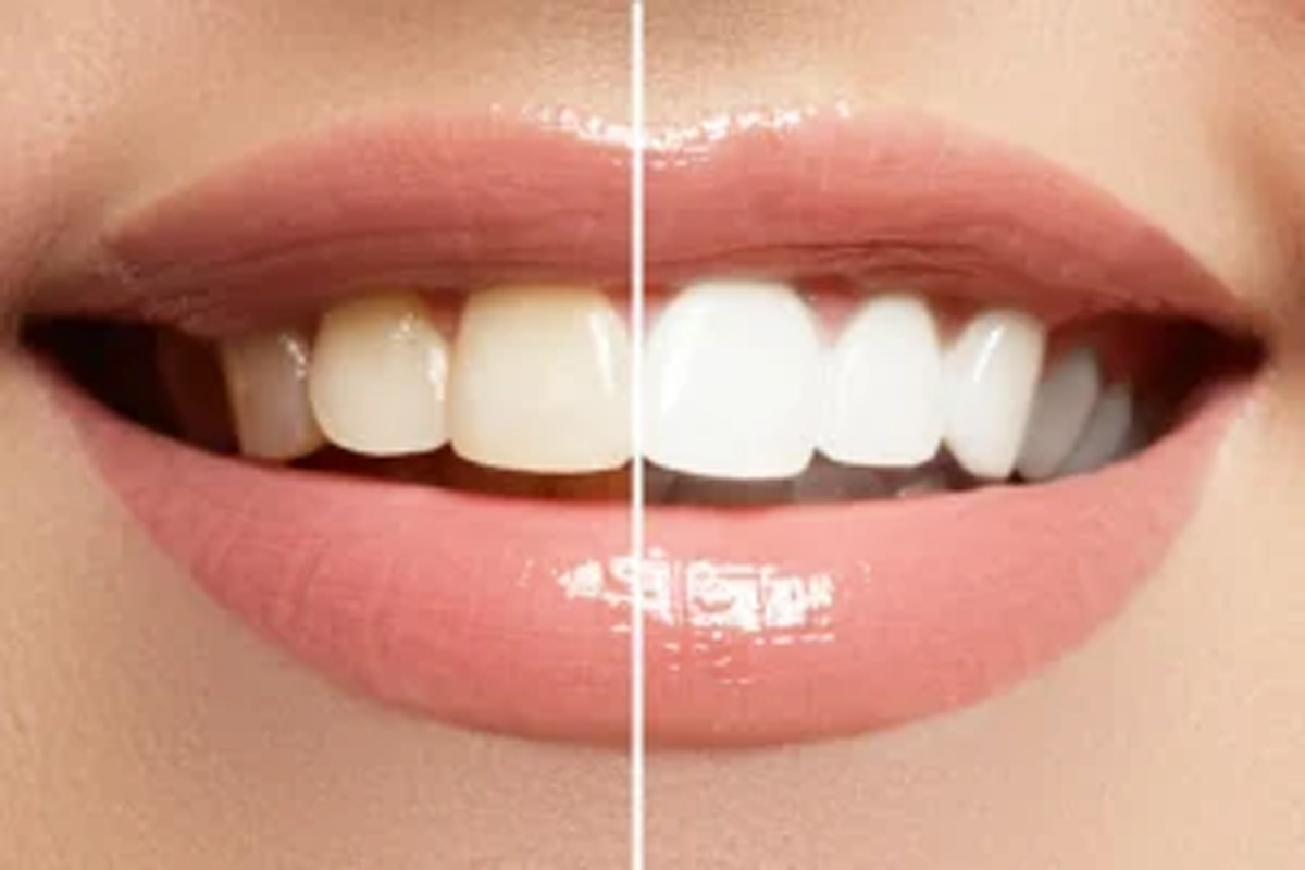 بیچینگ یا جرم گیری دندان-مرکز دندانپزشکی آرام