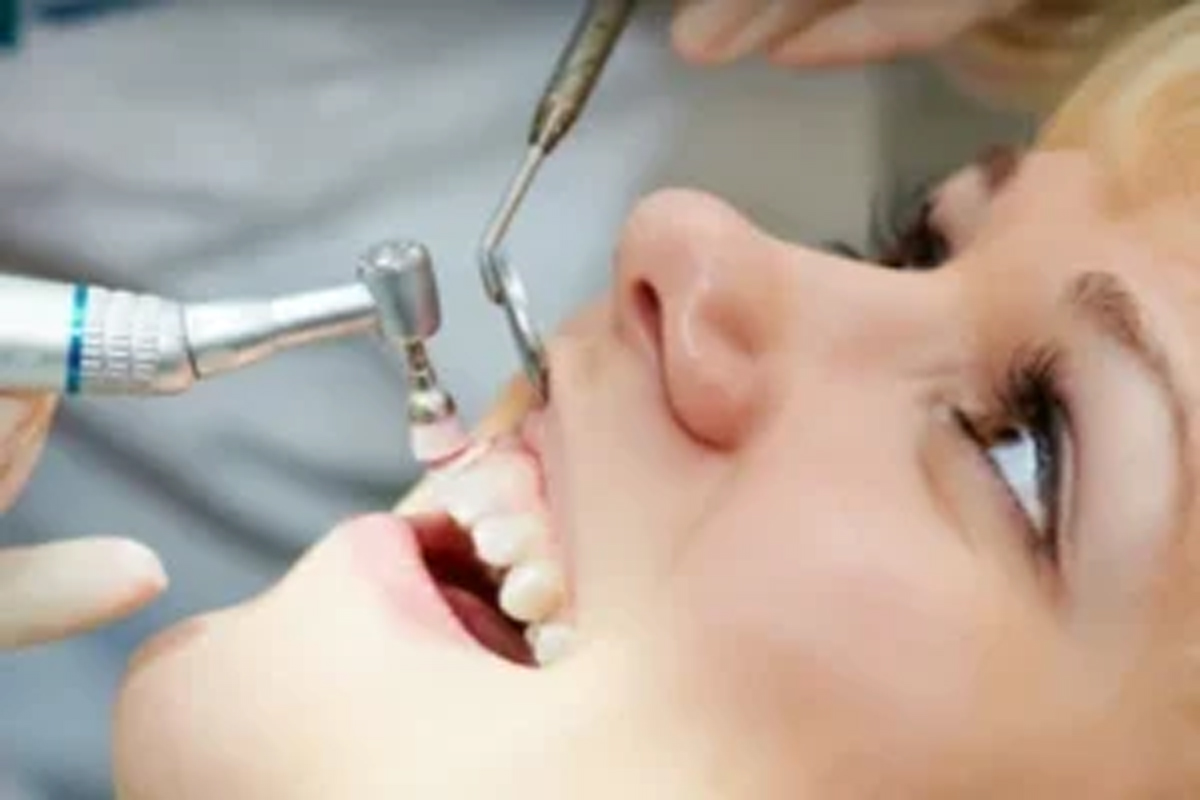 بیچینگ یا جرم گیری دندان-مرکز دندانپزشکی آرام