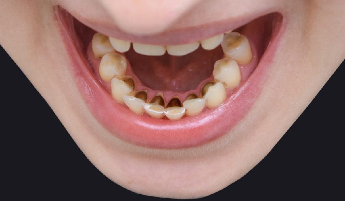 جرم گیری دندان سیاه-مرکز دندانپزشکی آرام