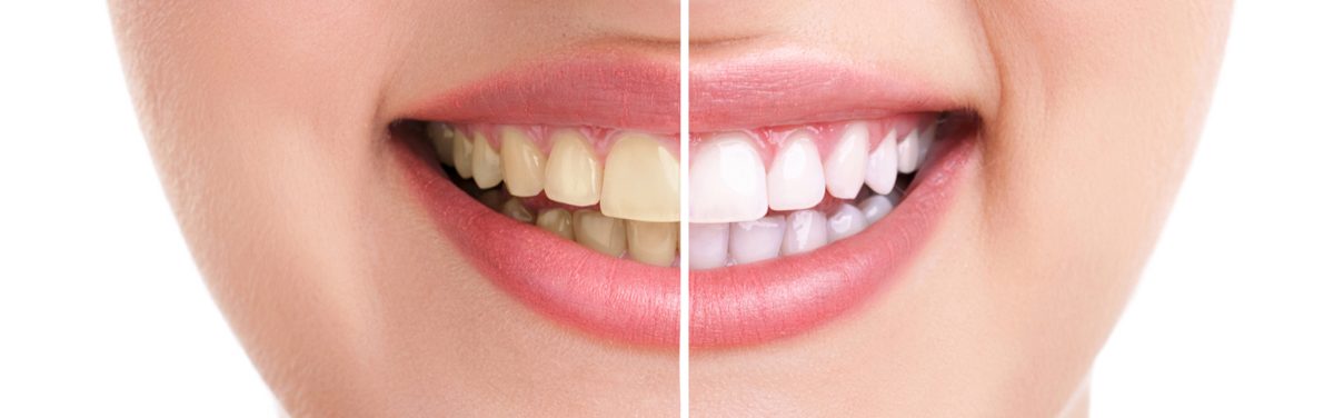 جرم گیری زردی دندان- دندانپزشکی گیشا آرام دنتال