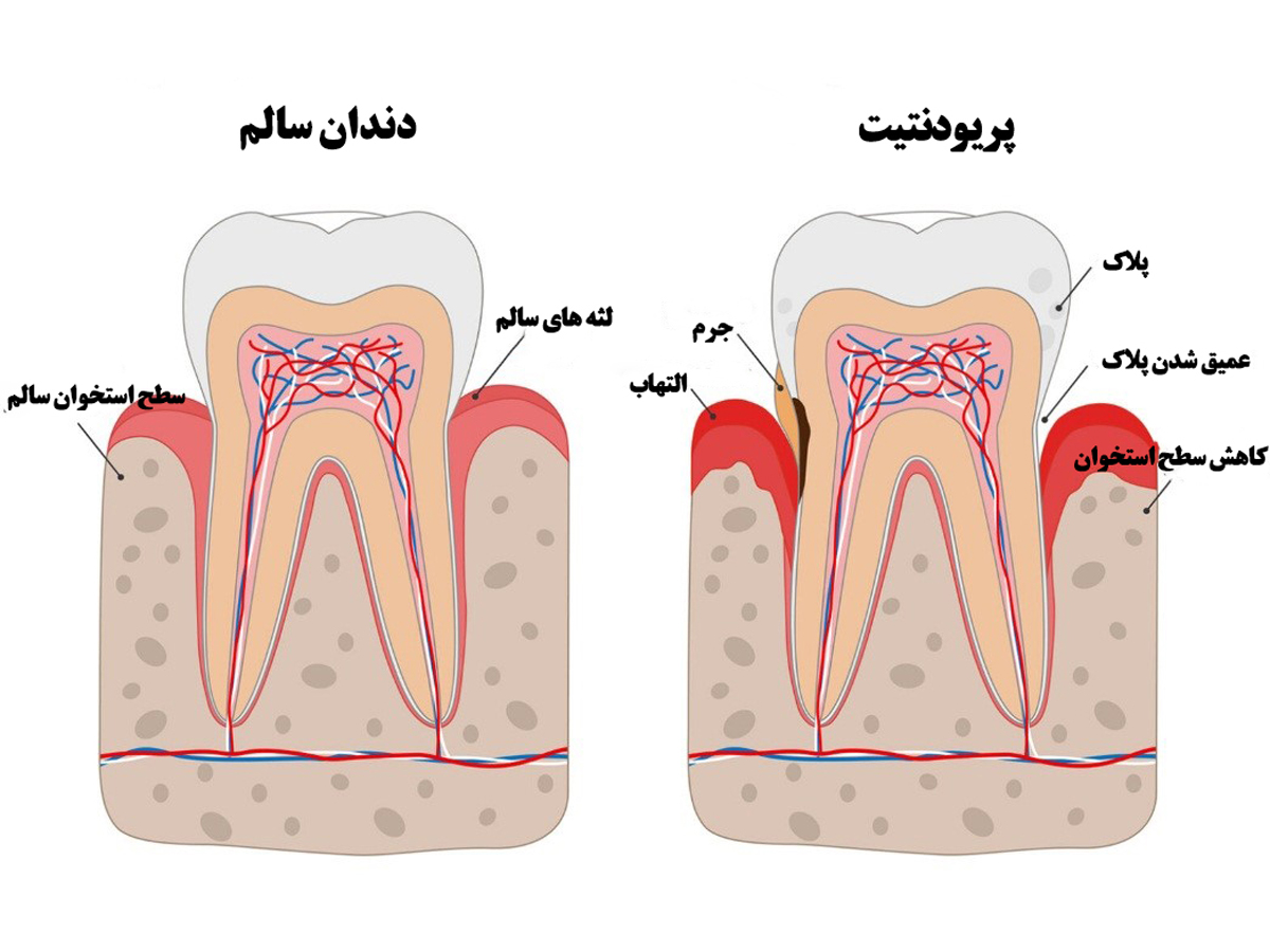 خونریزی-لثه-مرکز-دندانپزشکی-آرام 