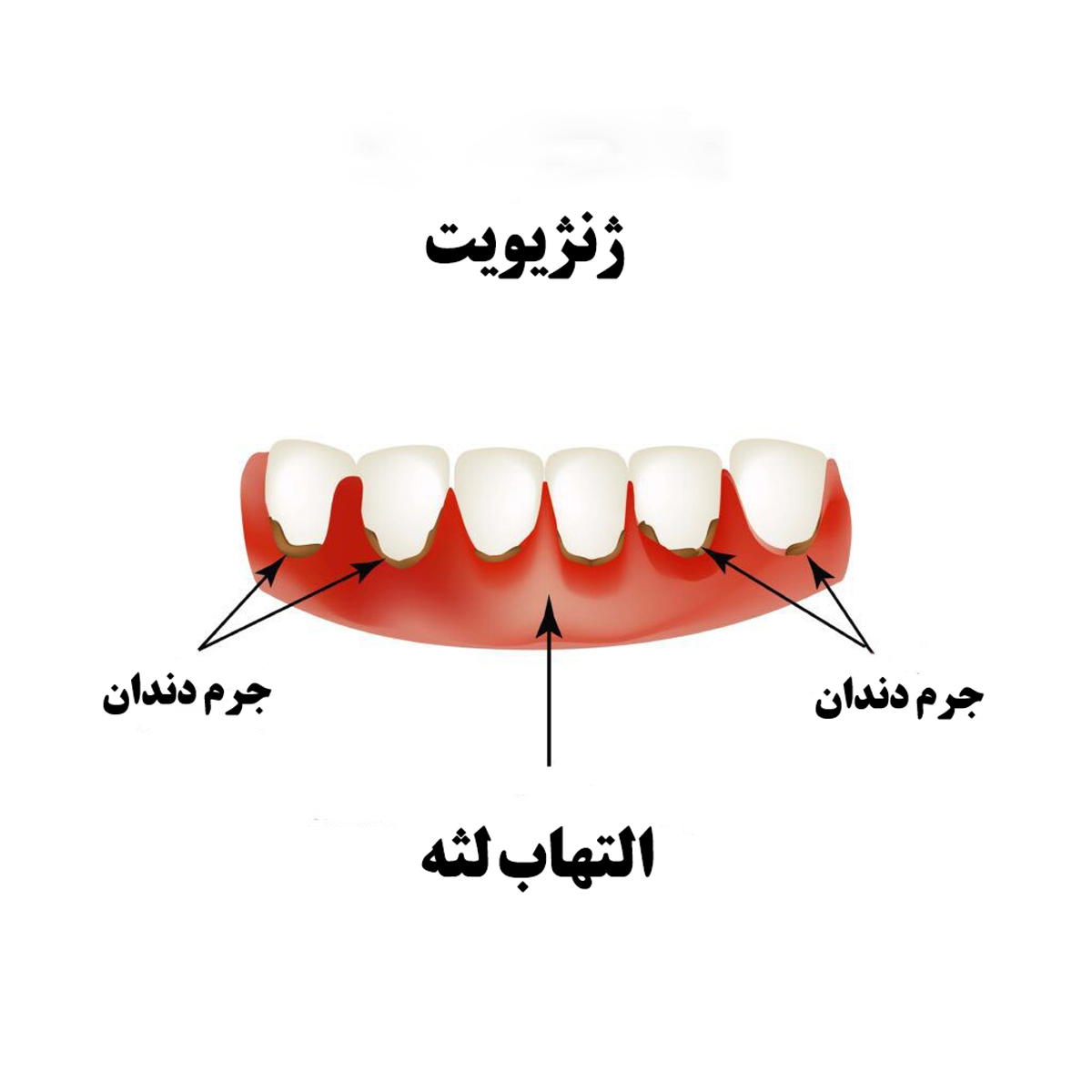 خونریزی-لثه-مرکز-دندانپزشکی-آرام