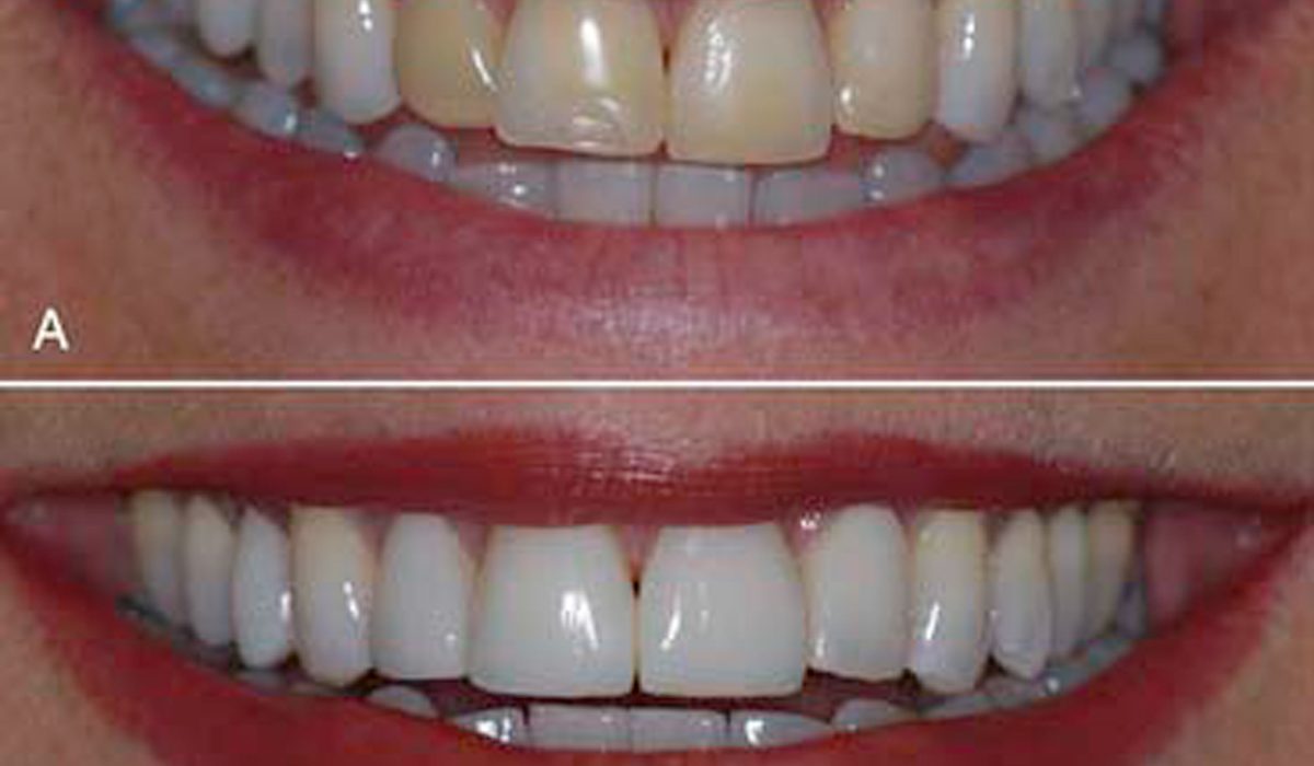 دلایل تغییر رنگ کامپوزیت-مرکز دندانپزشکی آرام