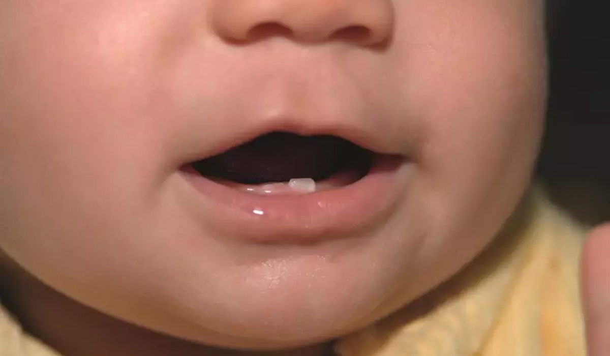 دندان درآوردن-مرکز دندانپزشکی آرام