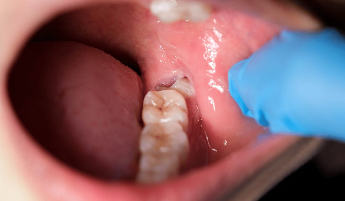 دندان عقل نهفته-مرکز دندانپزشکی گیشا آرام