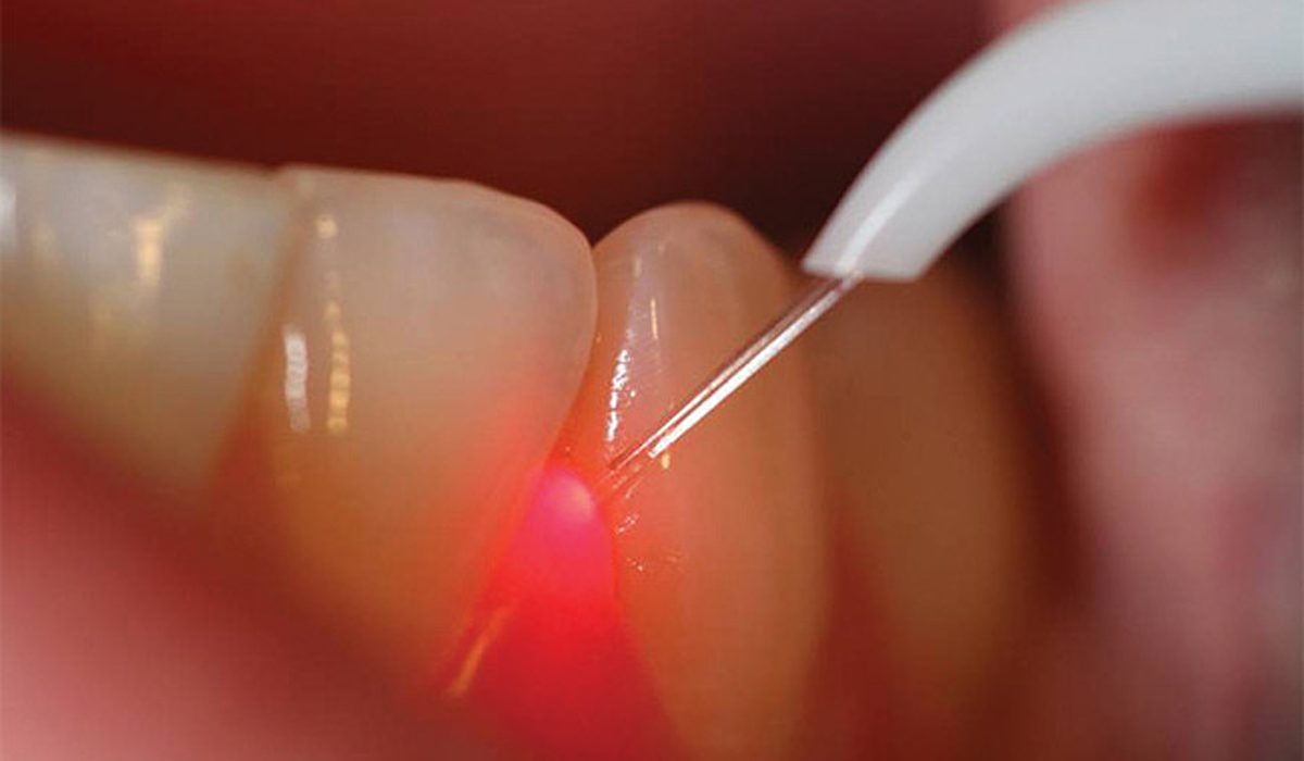 عصب کشی دندان با لیزر-مرکز دندانپزشکی گیشا آرام