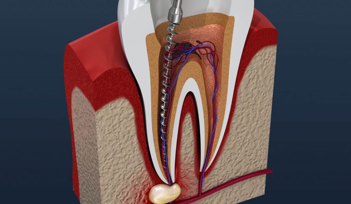 عصب کشی دندان- مرکز دندانپزشکی گیشا آرام