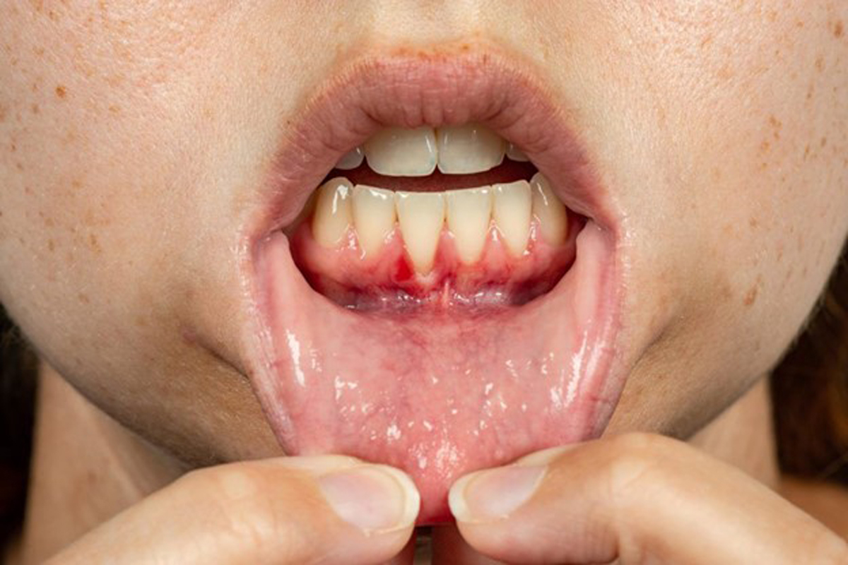 عفونت و التهاب لثه- مرکز دندانپزشکی گیشا آرام