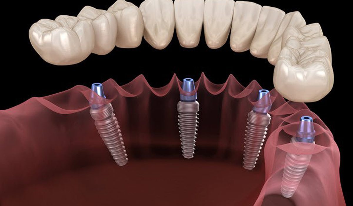 قیمت ایمپلنت و کاشت دندان-مرکز دندانپزشکی گیشا آرام