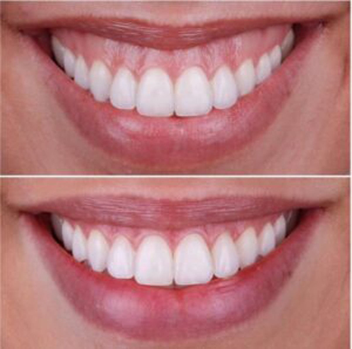 لبخند لثه ای -مرکز دندانپزشکی آرام