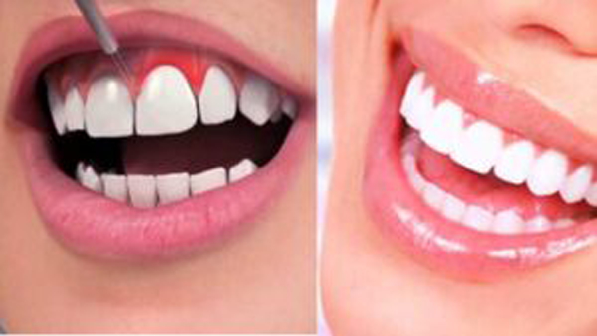 لبخند لثه ای -مرکز دندانپزشکی آرام