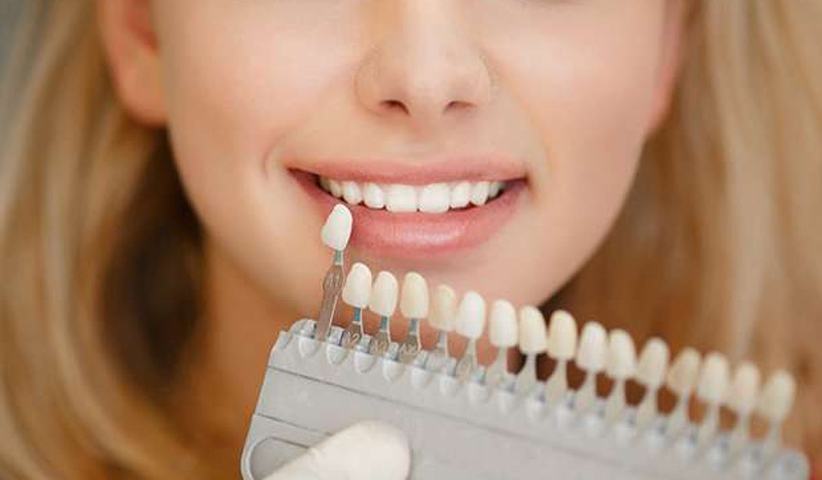 لومینیرز-مرکز دندانپزشکی گیشا آرام