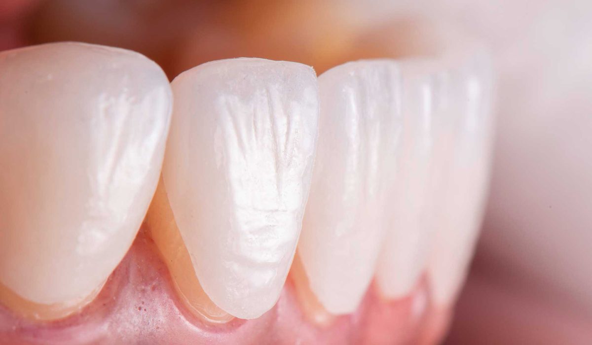 مراقبت های بعد از لمینت دندان-مرکز دندانپزشکی گیشا آرام