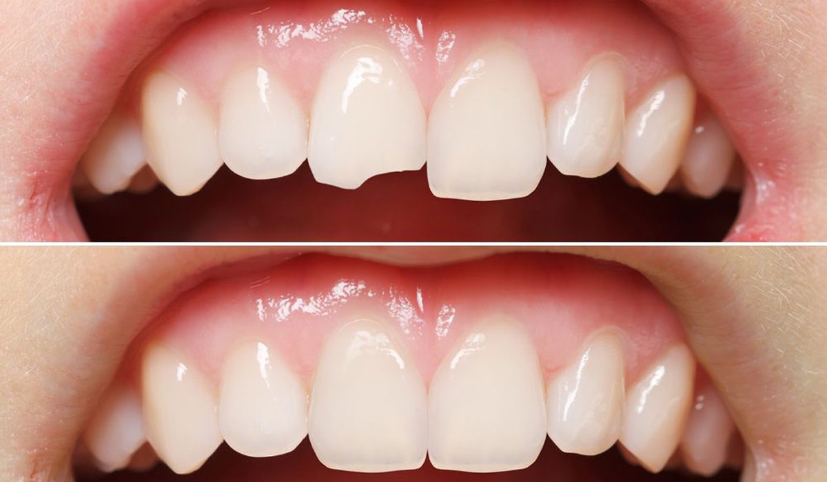 مراقبت های بعد از کامپوزیت-مرکز دندانپزشکی گیشا آرام