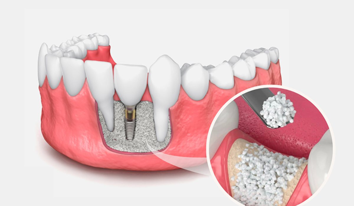 پیوند استخوان فک - مرکز دندانپزشکی گیشا آرام