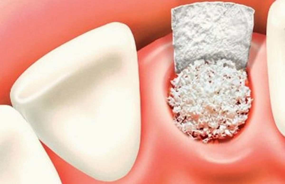 پیوند استخوان فک - مرکز دندانپزشکی گیشا آرام