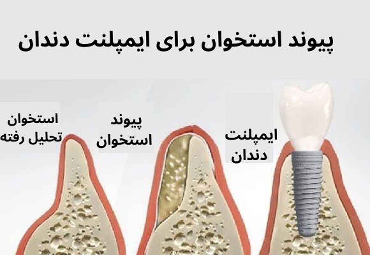 پیوند استخوان فک - مرکز دندانپزشکی گیشا آرام